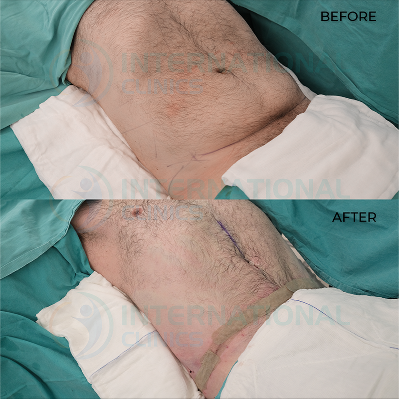  before and after Mini Tummy Tuck